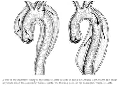 Acute-Aortic-Dissections_tear