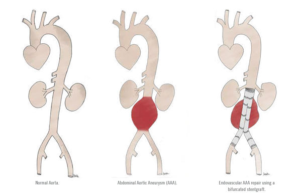 Thoracic and Abdominal Aortic Aneurysms